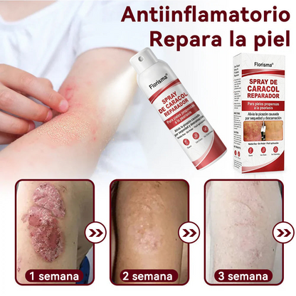 Florisma® 🎉SPRAY DE CADACOL REPARADOR  Para piel con psoriasis, con picazón y descamación💫