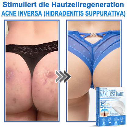 🌿  Fabricado en Alemania | Parche 2 en 1 de microagujas e hidrocoloide | Ayuda a mejorar la apariencia de lunares elevados, acné, verrugas planas y acrocordones | Ayuda a mejorar arrugas, cicatrices e imperfecciones de la piel
