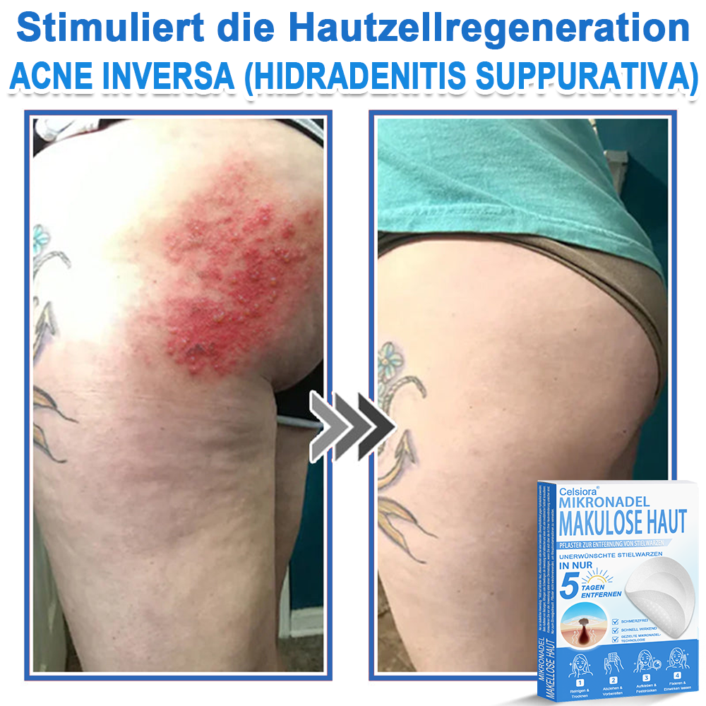 🌿  Fabricado en Alemania | Parche 2 en 1 de microagujas e hidrocoloide | Ayuda a mejorar la apariencia de lunares elevados, acné, verrugas planas y acrocordones | Ayuda a mejorar arrugas, cicatrices e imperfecciones de la piel