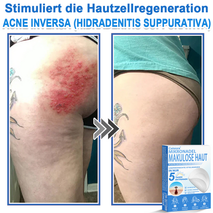 🌿  Fabricado en Alemania | Parche 2 en 1 de microagujas e hidrocoloide | Ayuda a mejorar la apariencia de lunares elevados, acné, verrugas planas y acrocordones | Ayuda a mejorar arrugas, cicatrices e imperfecciones de la piel