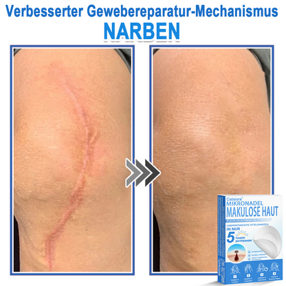 🌿  Fabricado en Alemania | Parche 2 en 1 de microagujas e hidrocoloide | Ayuda a mejorar la apariencia de lunares elevados, acné, verrugas planas y acrocordones | Ayuda a mejorar arrugas, cicatrices e imperfecciones de la piel