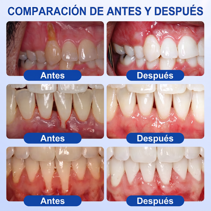 👩‍⚕️𝑮𝒍𝒊𝒎𝒎𝒆𝒓𝒍𝒚® 🦷 𝑮𝒖𝒎𝑹𝒆𝒗𝒊𝒗𝒆 𝑮𝒆𝒍 𝒅𝒆 𝑹𝒆𝒑𝒂𝒓𝒂𝒄𝒊ó𝒏 𝑷𝒂𝒓𝒐𝒅𝒐𝒏𝒕𝒂𝒍 💓