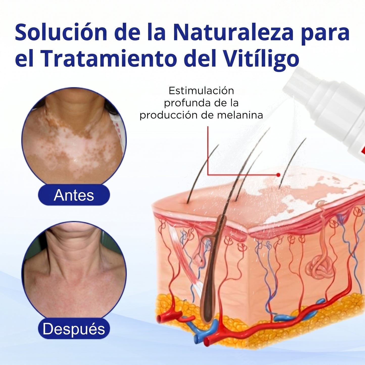Florisma®🌷🥑 spray de cuidado para el vitíligo – resultados visibles en pocas semanas, 100 % natural y sin esteroides