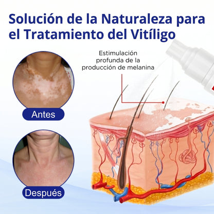 Florisma®🌷🥑 spray de cuidado para el vitíligo – resultados visibles en pocas semanas, 100 % natural y sin esteroides