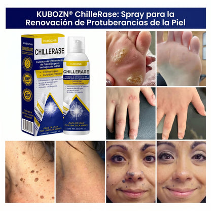 KUBOZN®🌿ChillErase Spray de Renovación contra Protuberancias💫