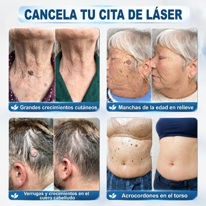 💚𝐁𝐨𝐫𝐫𝐚𝐝𝐨𝐫 𝐝𝐞 𝐕𝐞𝐫𝐫𝐮𝐠𝐚𝐬 𝐲 𝐌𝐚𝐧𝐜𝐡𝐚𝐬 𝐝𝐞 𝟕 𝐃í𝐚𝐬(Aplicador roll-on: sin do🍵