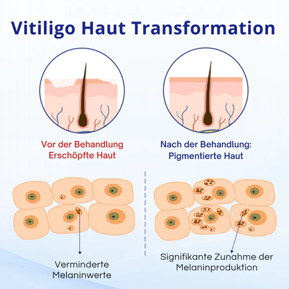 KUBOZN® Vitiligo-Behandlungsspray – Sichtbare Ergebnisse in wenigen Wochen, 100 % natürlich und steroidfrei