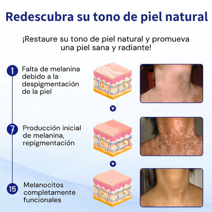 Florisma®🌷🥑 spray de cuidado para el vitíligo – resultados visibles en pocas semanas, 100 % natural y sin esteroides