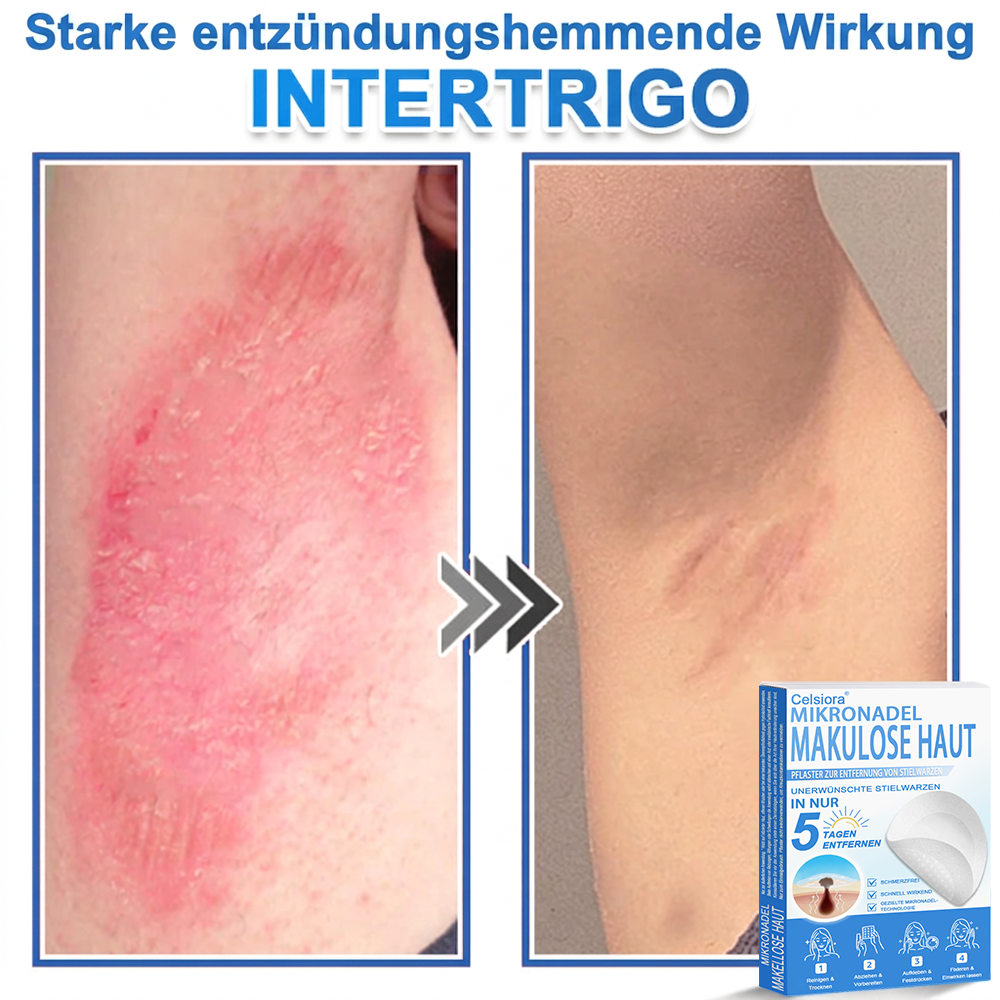 🌿  Fabricado en Alemania | Parche 2 en 1 de microagujas e hidrocoloide | Ayuda a mejorar la apariencia de lunares elevados, acné, verrugas planas y acrocordones | Ayuda a mejorar arrugas, cicatrices e imperfecciones de la piel