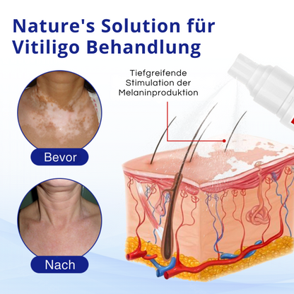 KUBOZN® Vitiligo-Behandlungsspray – Sichtbare Ergebnisse in wenigen Wochen, 100 % natürlich und steroidfrei