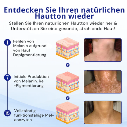 KUBOZN® Vitiligo-Behandlungsspray – Sichtbare Ergebnisse in wenigen Wochen, 100 % natürlich und steroidfrei
